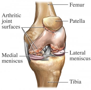 Best Knee Support For Meniscus Injury