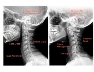 Whiplash x-ray