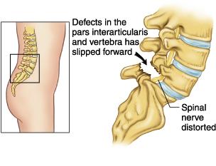 St George Spondylolisthesis