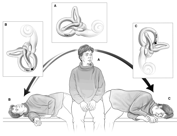 how to get rid of migraine vertigo