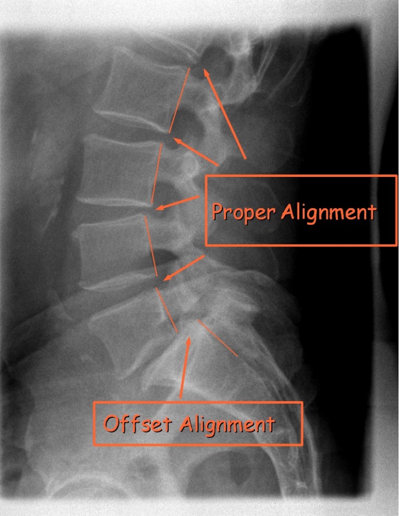 Spondylolisthesis x-ray St George Chiropractor