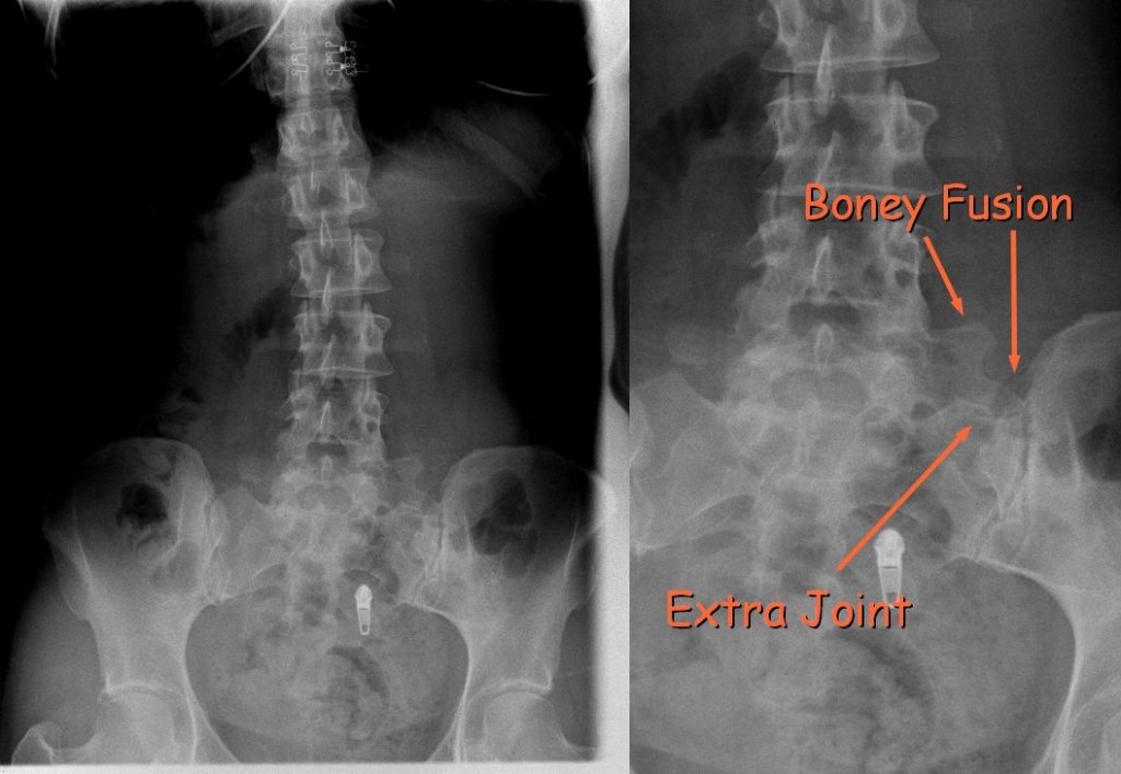 Transitional Segment - Boney Anomaly