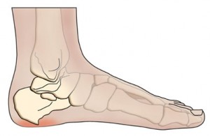 Heel spur pain Chiropractor St George UT