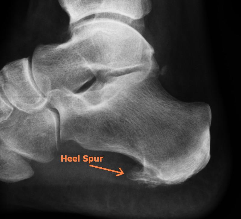How to Dissolve Bone Spurs Naturally | Ankle & Foot Centers
