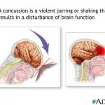 Concussion Injury to Brain