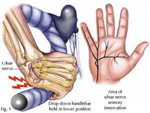 Guyon Syndrome