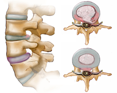 Bulging & Herniated Discs, Chiropractor in Sioux City, IA