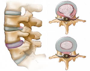 Slipped Disc St George Chiropractor