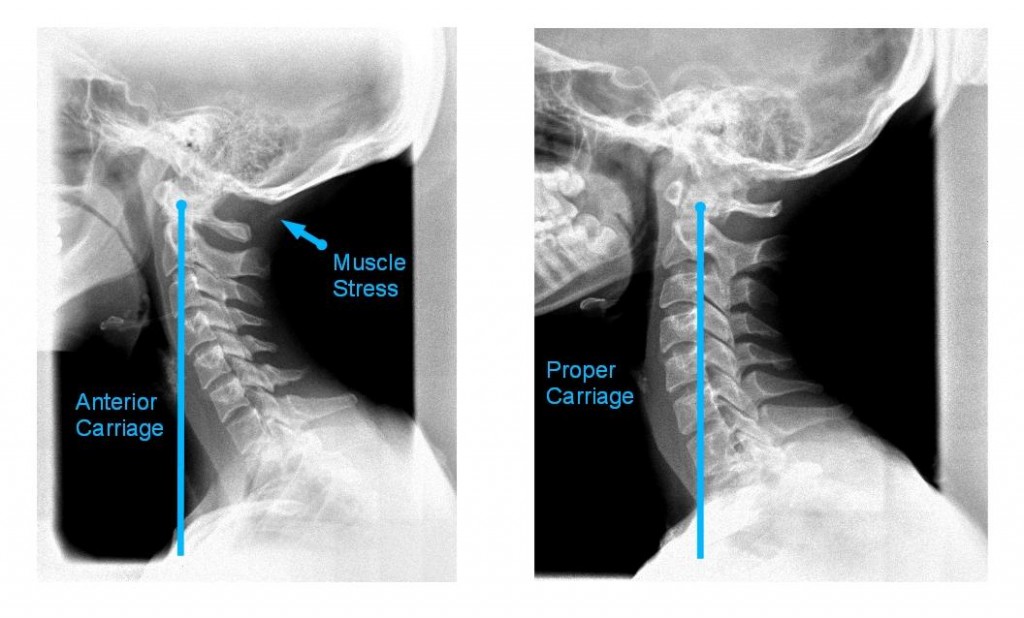 Chiropractors correct bad posture