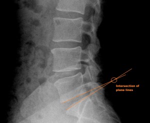 lateral lumbar x-ray