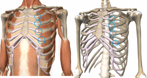 Costochondritis occurs right at the bone and cartilage junction