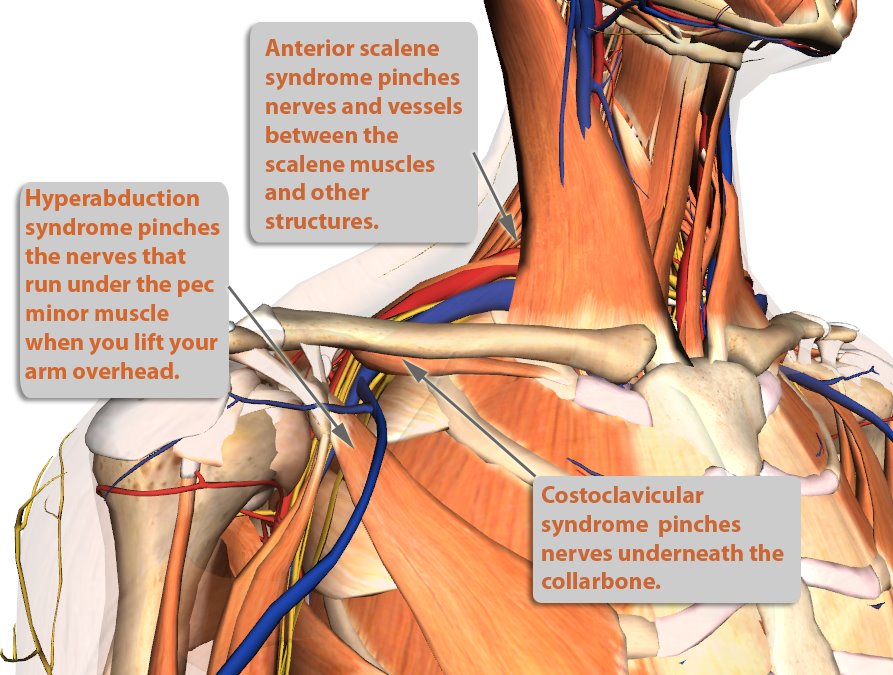 Thoracic Outlet Syndrome Treatment -Innova Pain Clinic